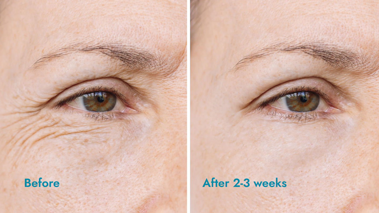 Botox fine lines before after ZMD aesthetics Zarina Tustin