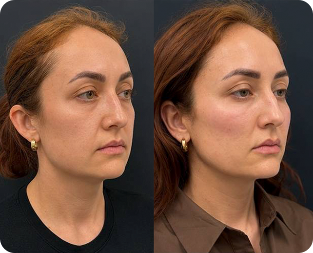 Side-by-side comparison of a woman before and after skincare treatment, showing clearer skin and improved complexion.