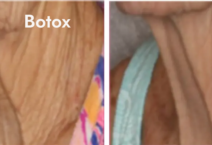 Close-up of a person's skin showing the effects of Botox treatment on the forehead, with a comparison to a non-treated area.