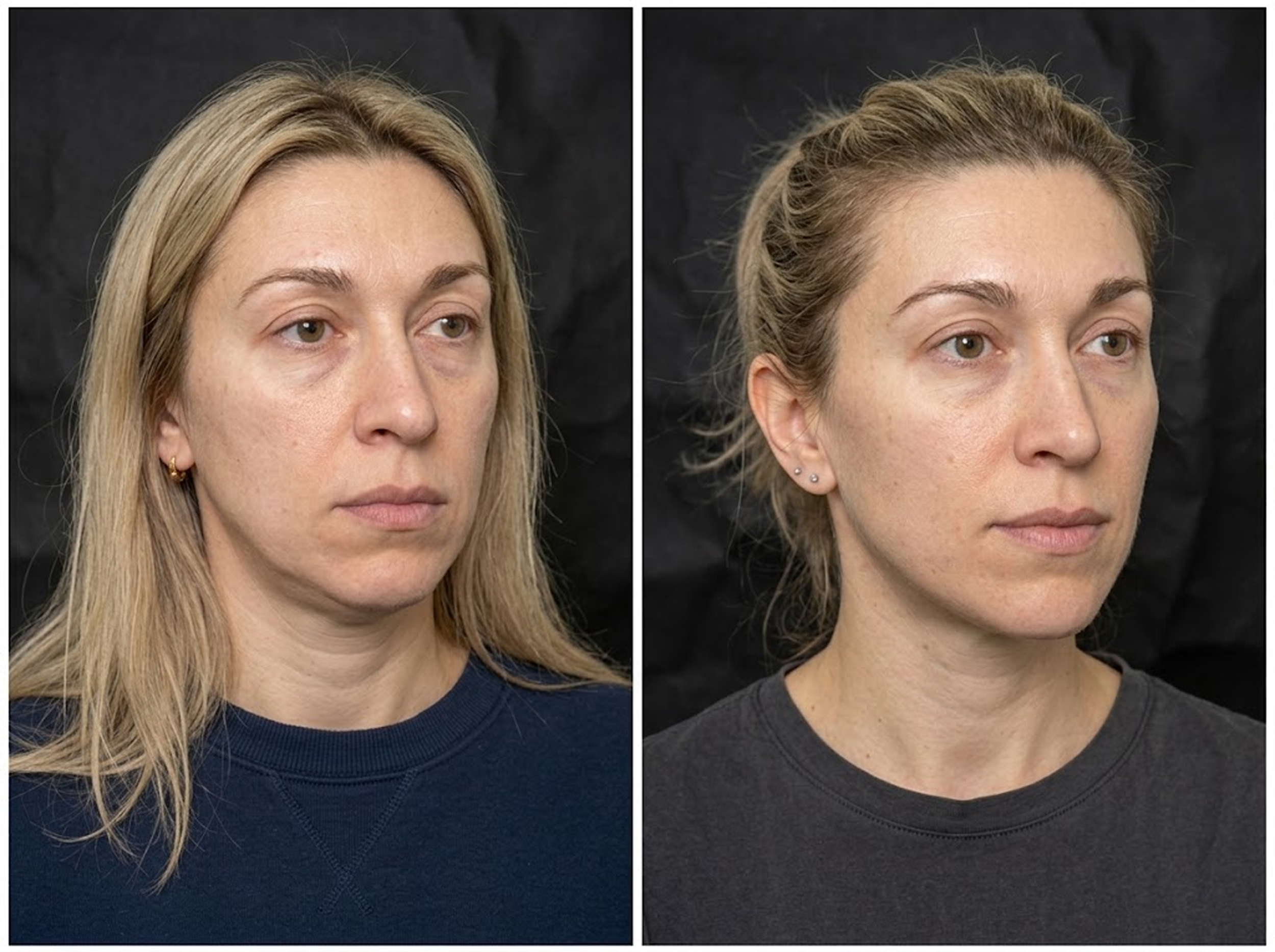 Side-by-side comparison of a woman's face before and after skincare treatment or cosmetic procedure, showing reduced under-eye bags and improved skin texture.