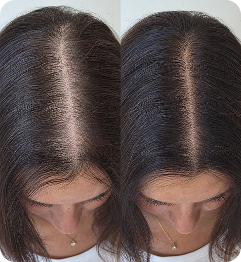 Comparison of scalp before and after hair treatment showing reduced hair thinning and increased hair density.