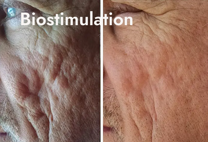 Close-up photo showing the skin on a person's face before and after biostimulation treatment, with visible improvement in skin texture.