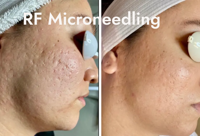 Side-by-side comparison of a woman's cheek before and after RF microneedling treatment, showing reduced acne scars and improved skin texture.