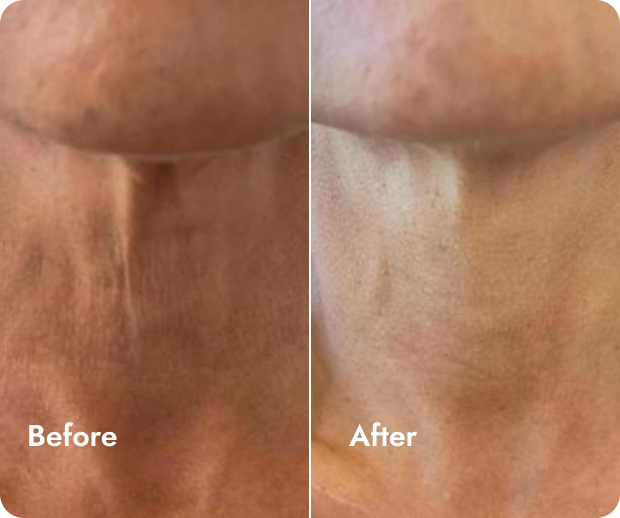 Close-up of a neck showing a comparison of skin appearance before and after treatment, with smoother skin in the after photo.