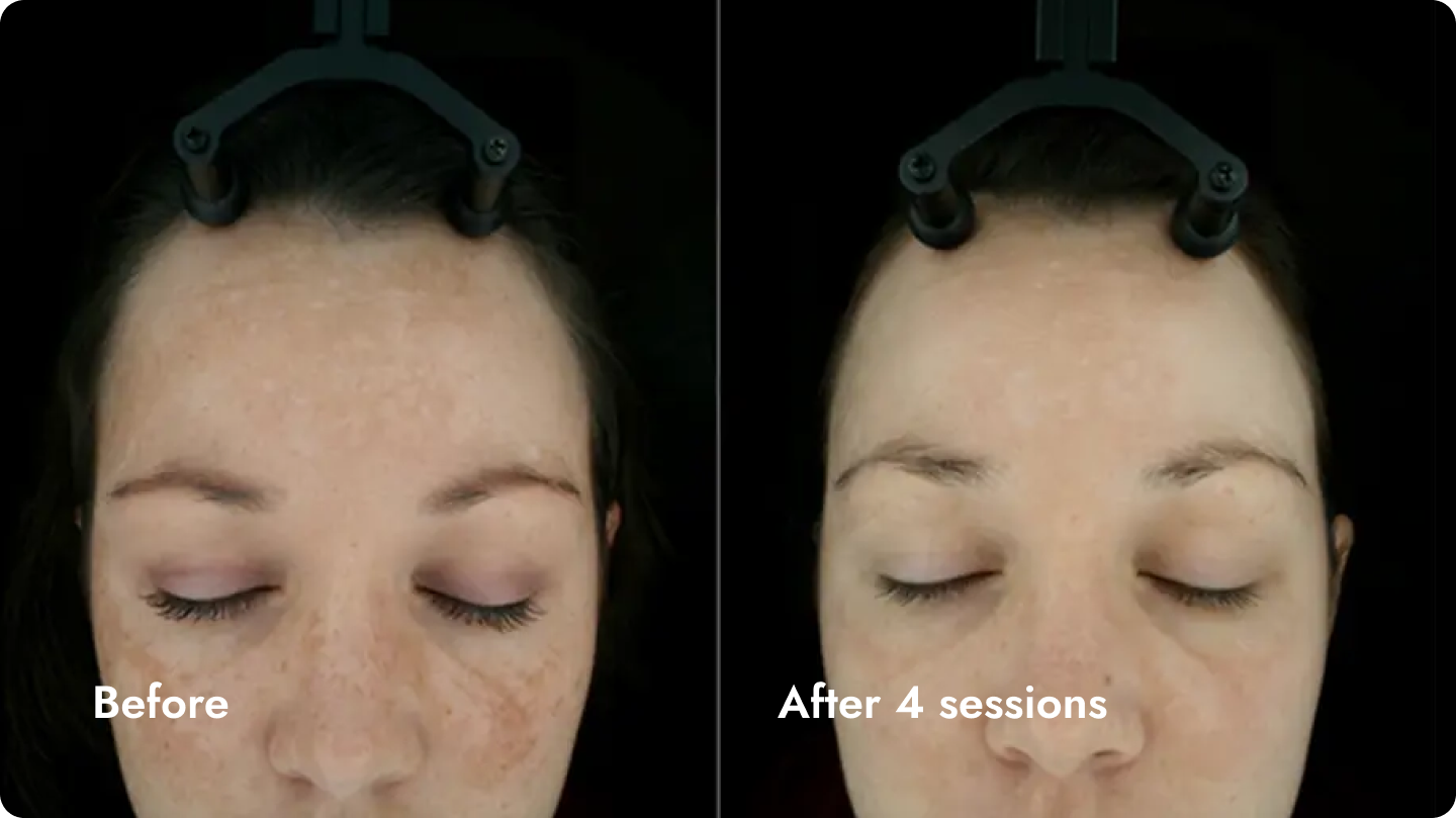 Side-by-side comparison of a woman's face before and after four skincare sessions, showing reduced freckles and clearer skin.
