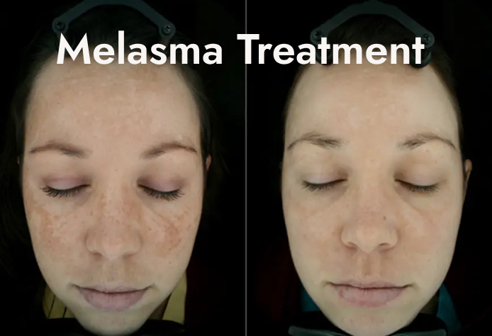 Side-by-side comparison of a woman's face showing the results of melasma treatment, with the left side depicting more hyperpigmentation and the right side showing clearer skin.