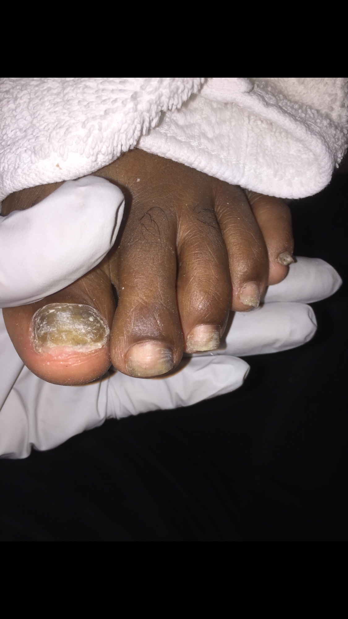 Close-up of a person's toes with thick, discolored, and fungal toenails, being examined or treated by a healthcare professional wearing gloves, with a white towel partially covering the foot.