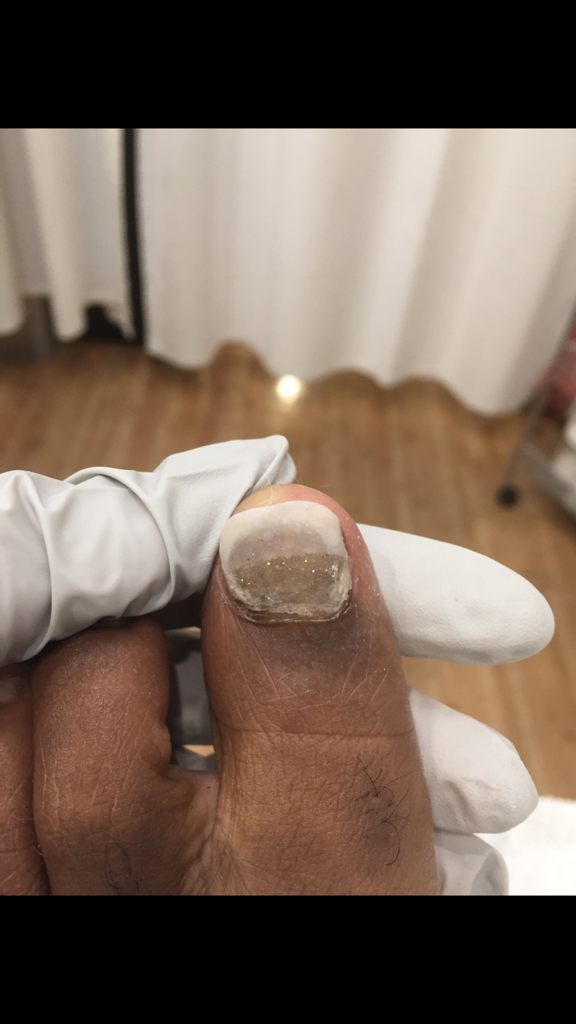 Close-up of a person's thumb with a clear nail overlay, being held with gloved hand in a medical or dental setting, with a blurred background of a curtain and wooden floor.