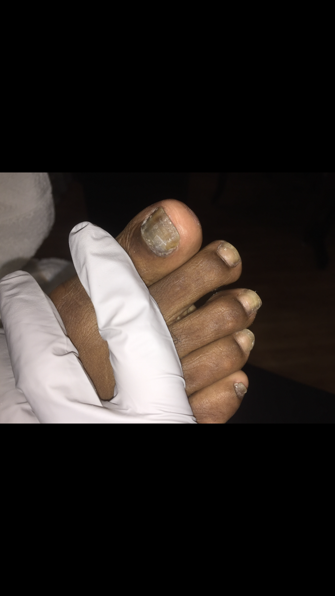 Close-up of a person's toes with discolored, thickened, and deformed toenails, held by a gloved hand.