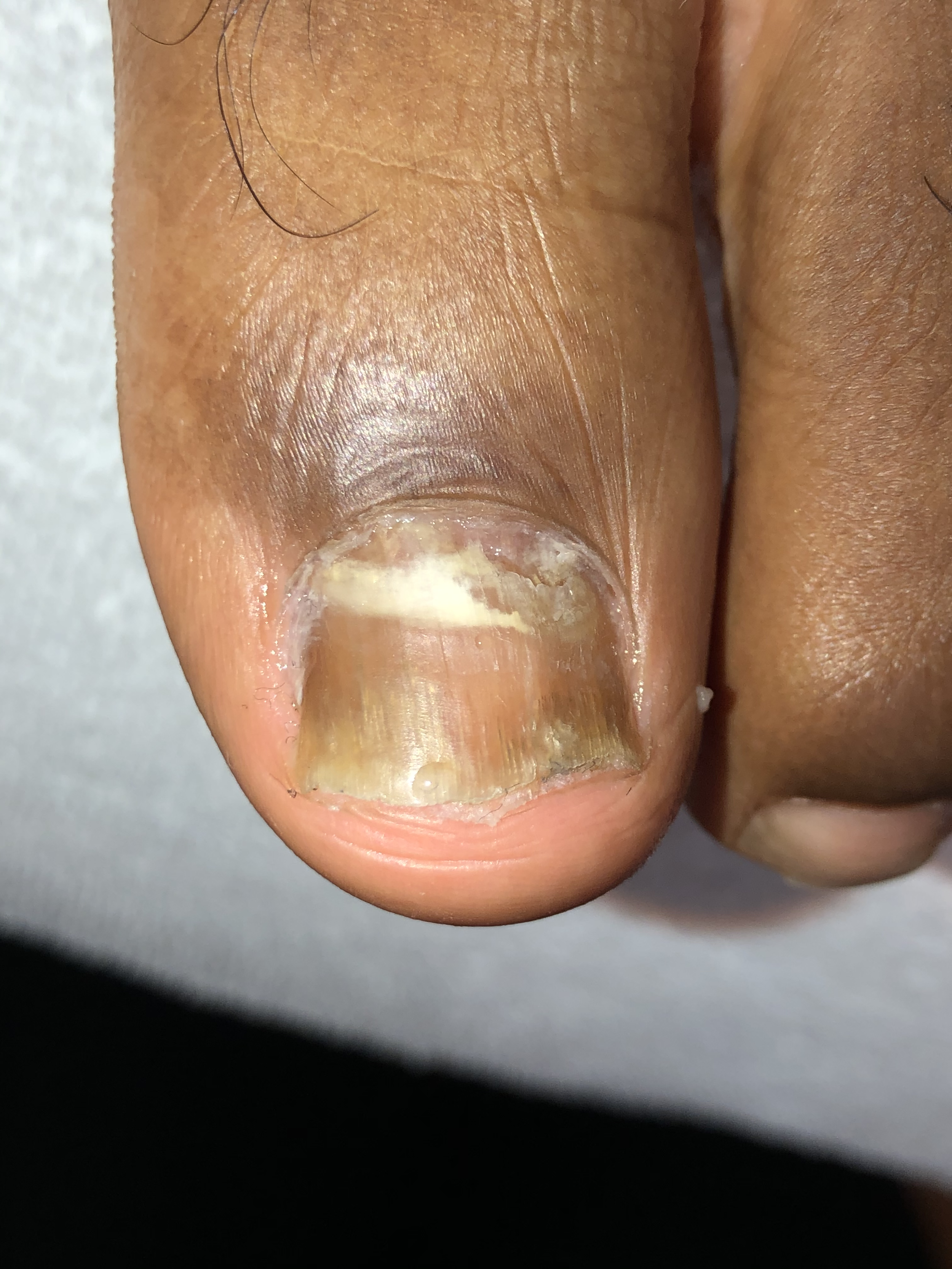Close-up of a person's fingernail with visible nail damage and discoloration.