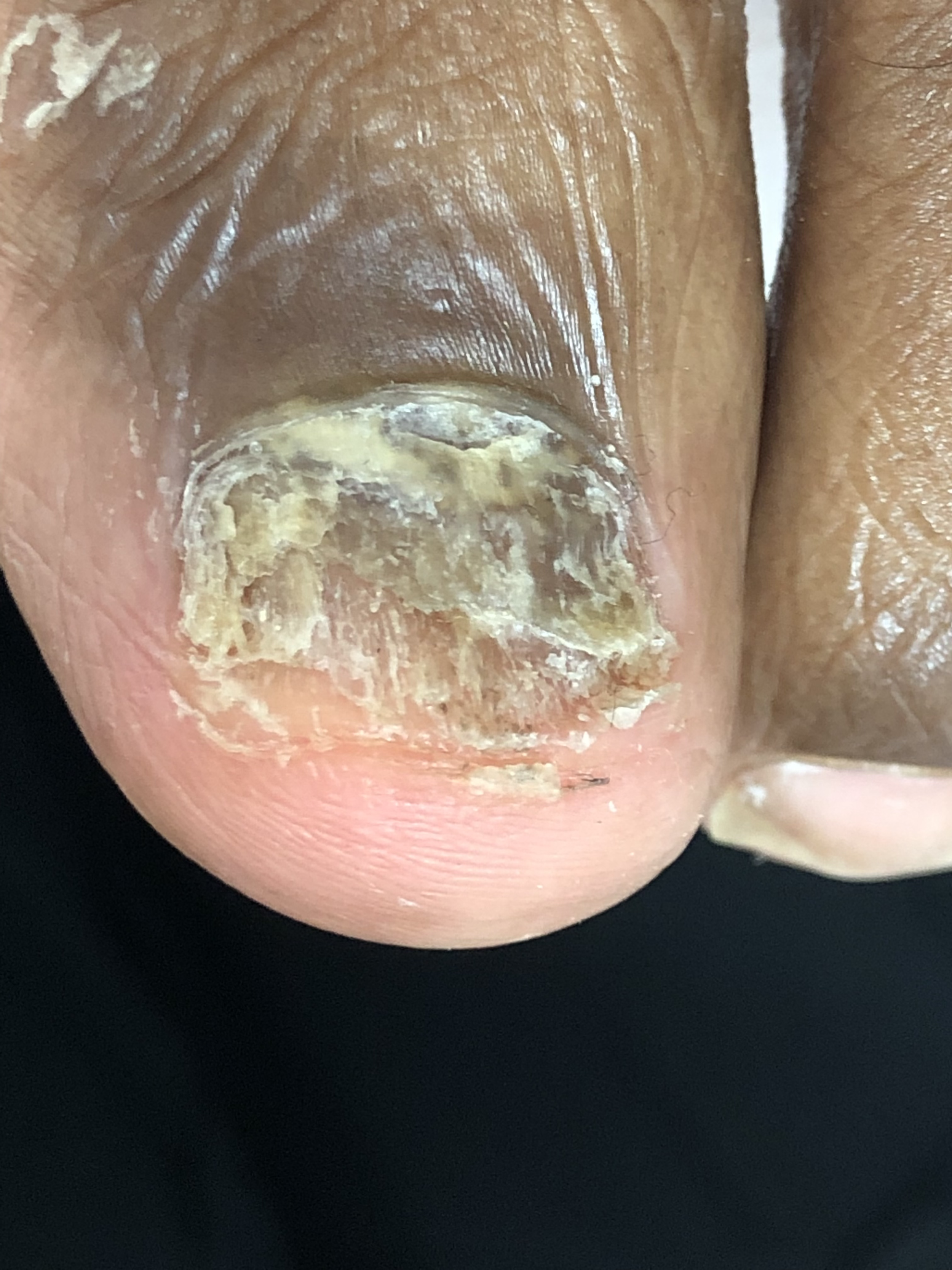 Close-up of a toenail with thickened, discolored, and damaged nail tissue, indicative of a fungal infection.