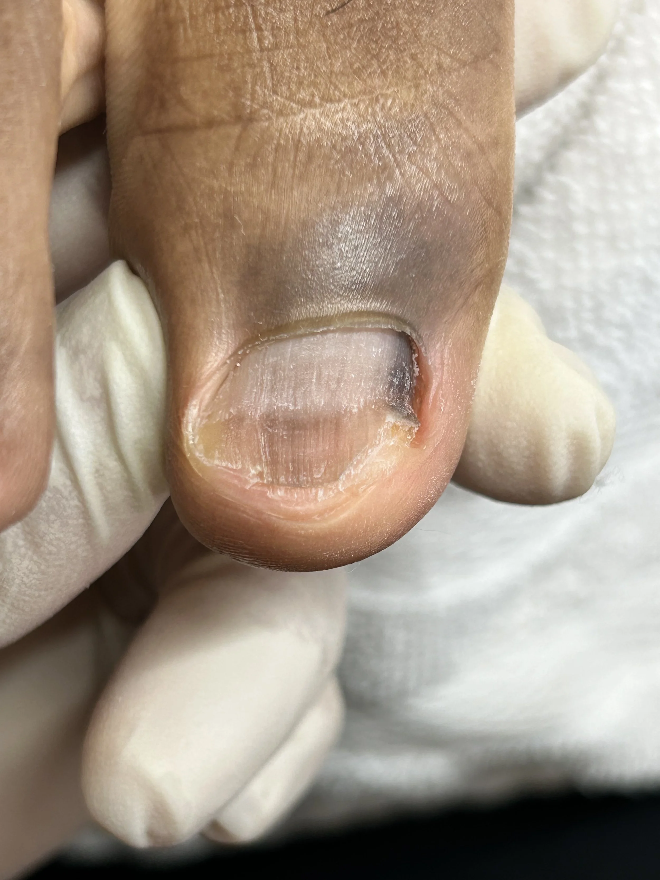 Close-up of a person's toenail with a fungal infection, showing discoloration and thickening.