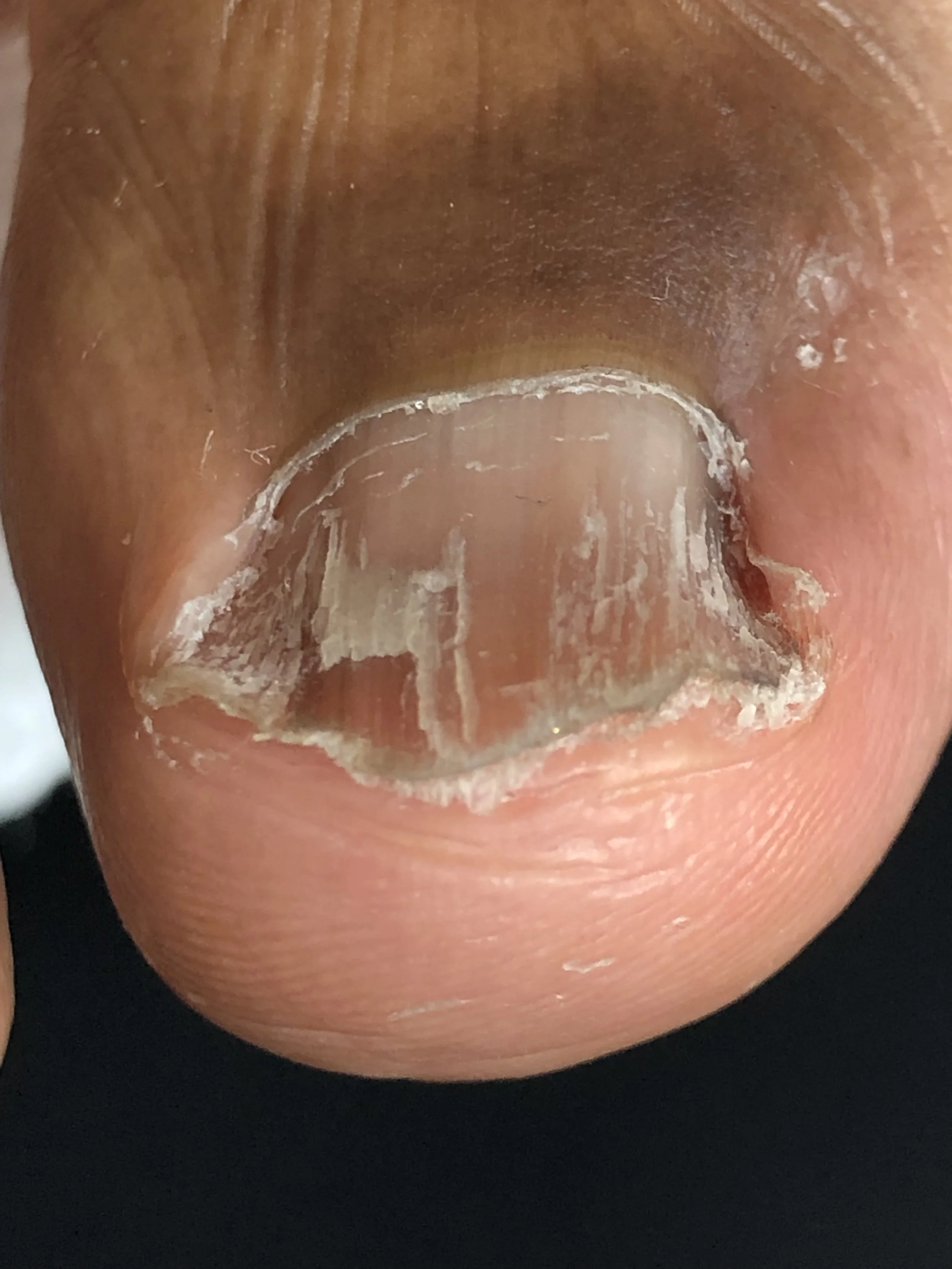 Close-up of a person's toenail with a fungal infection characterized by discoloration and thickening.