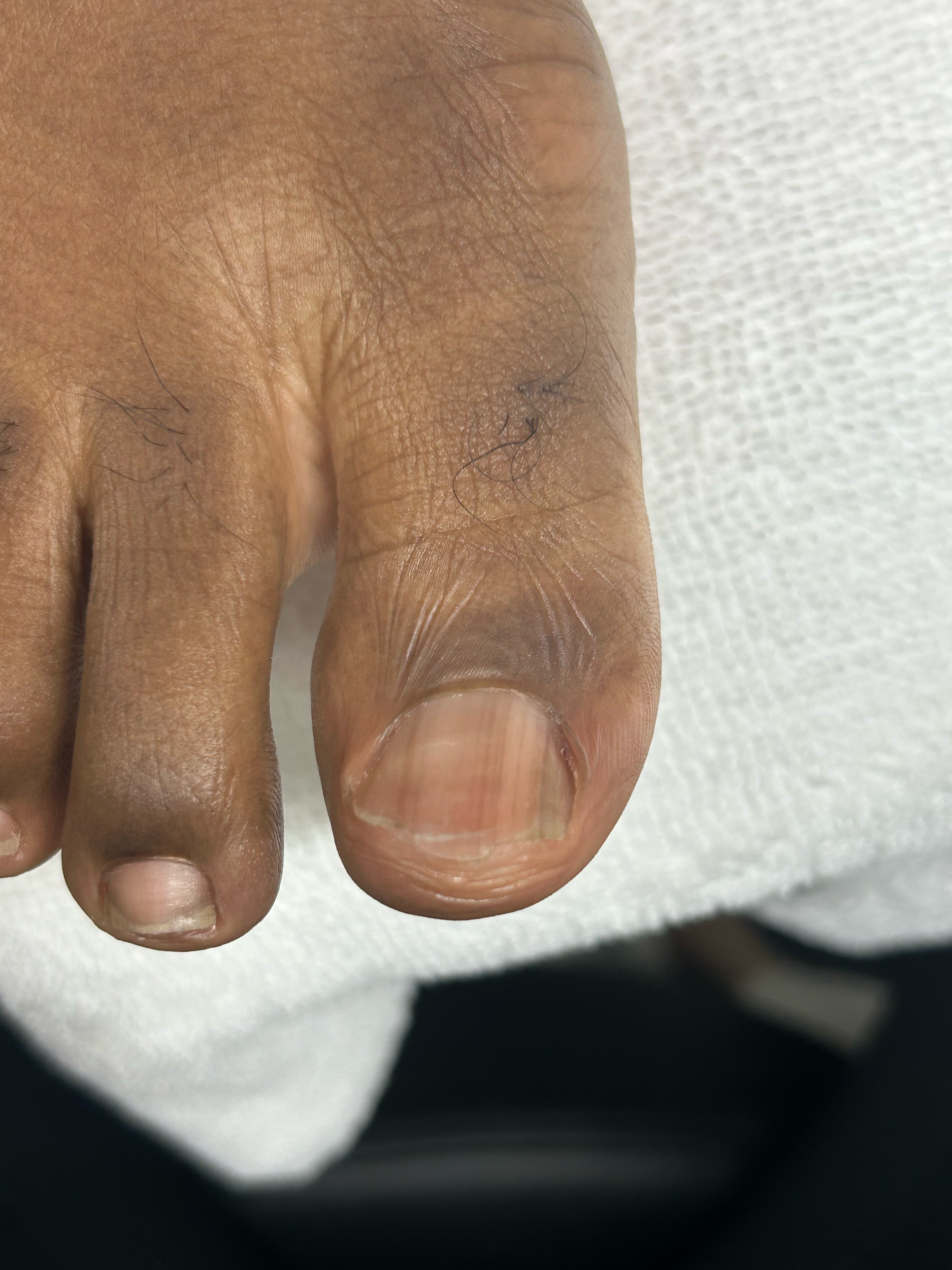 Close-up of a person's hand showing dry, cracked skin with prominent wrinkles.