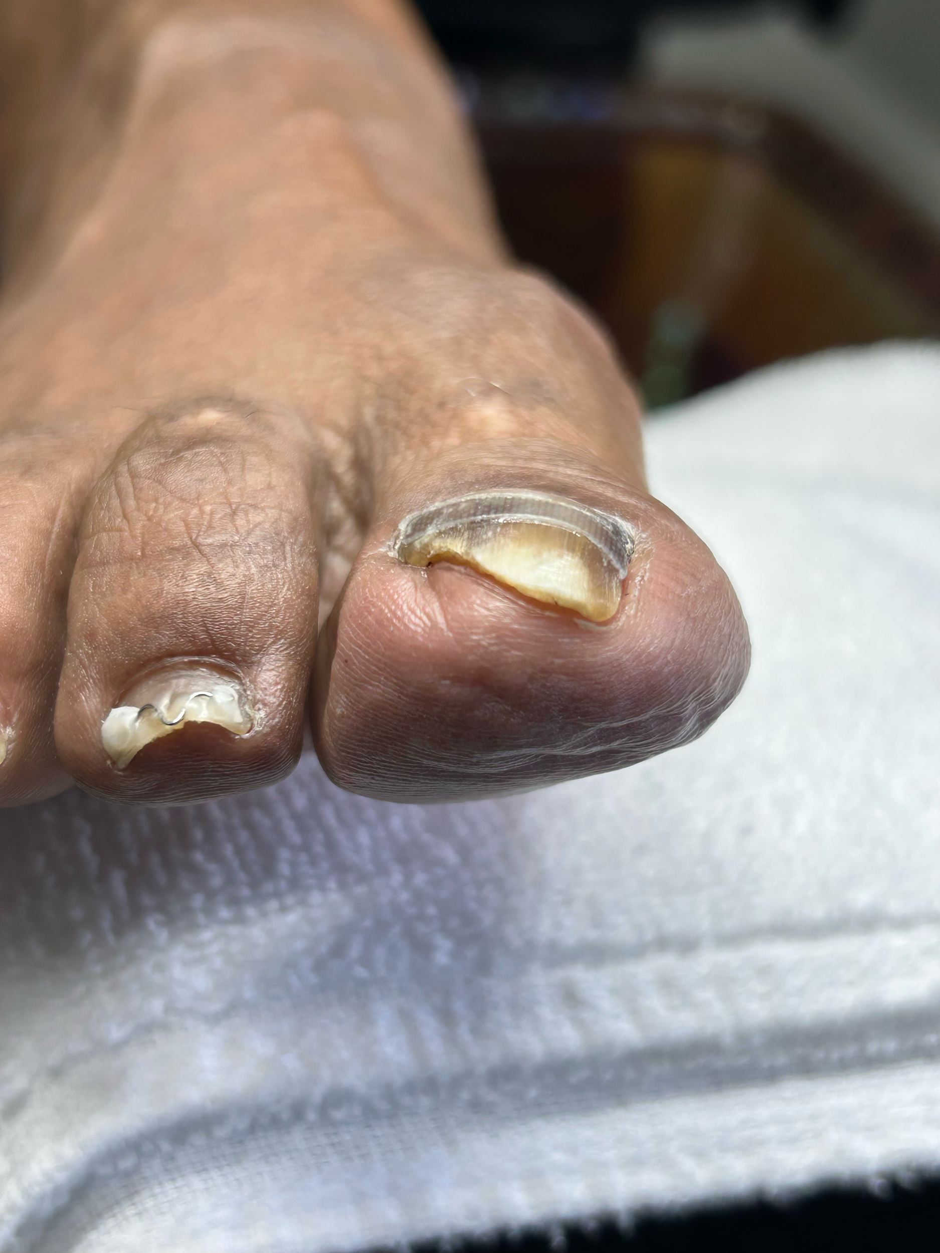 Close-up of a person's thumb with a toenail that has a fungal infection, appearing thickened, yellowed, and crumbly.