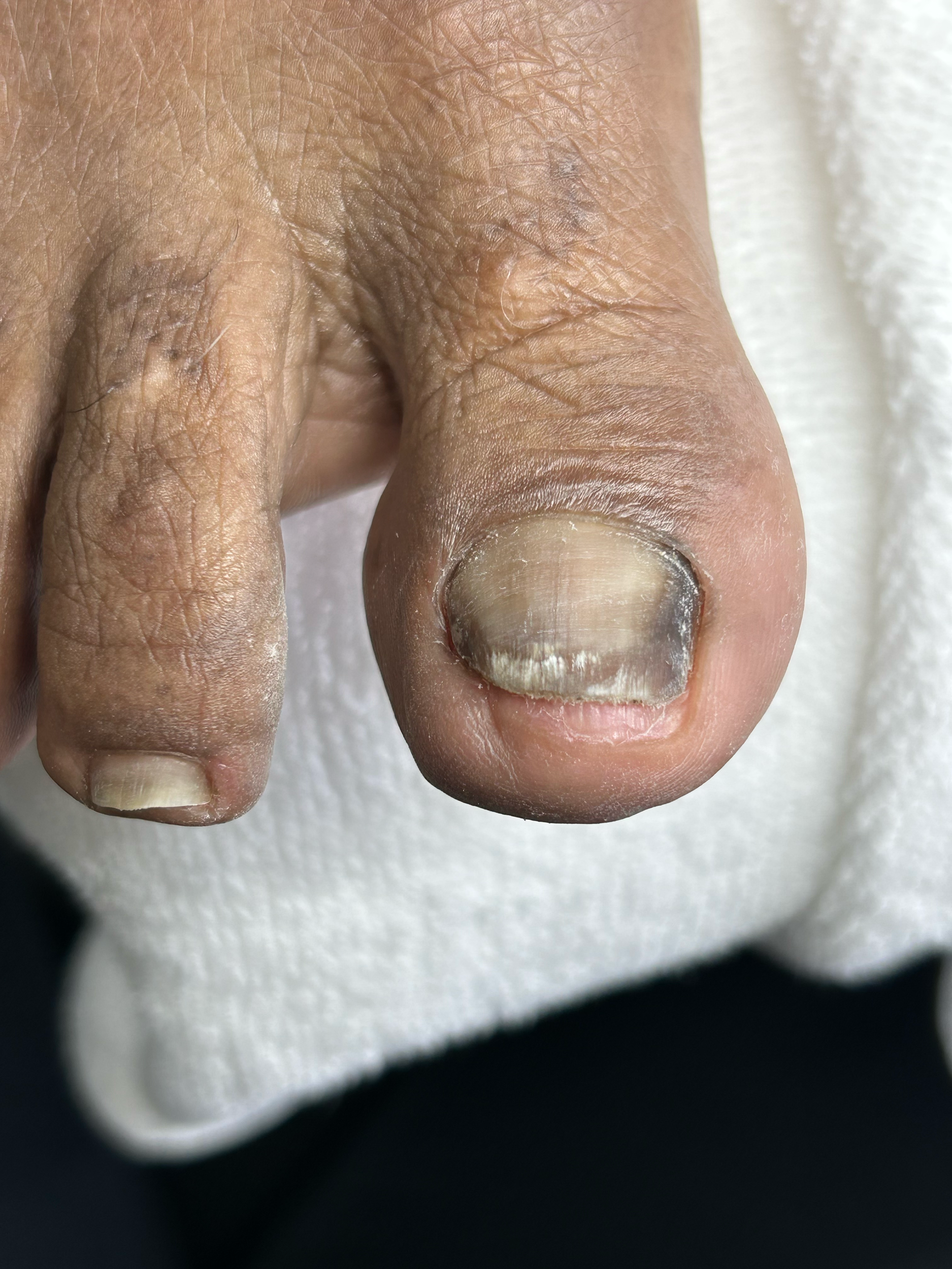 Close-up of a human fingernail on a finger with dry, cracked skin.