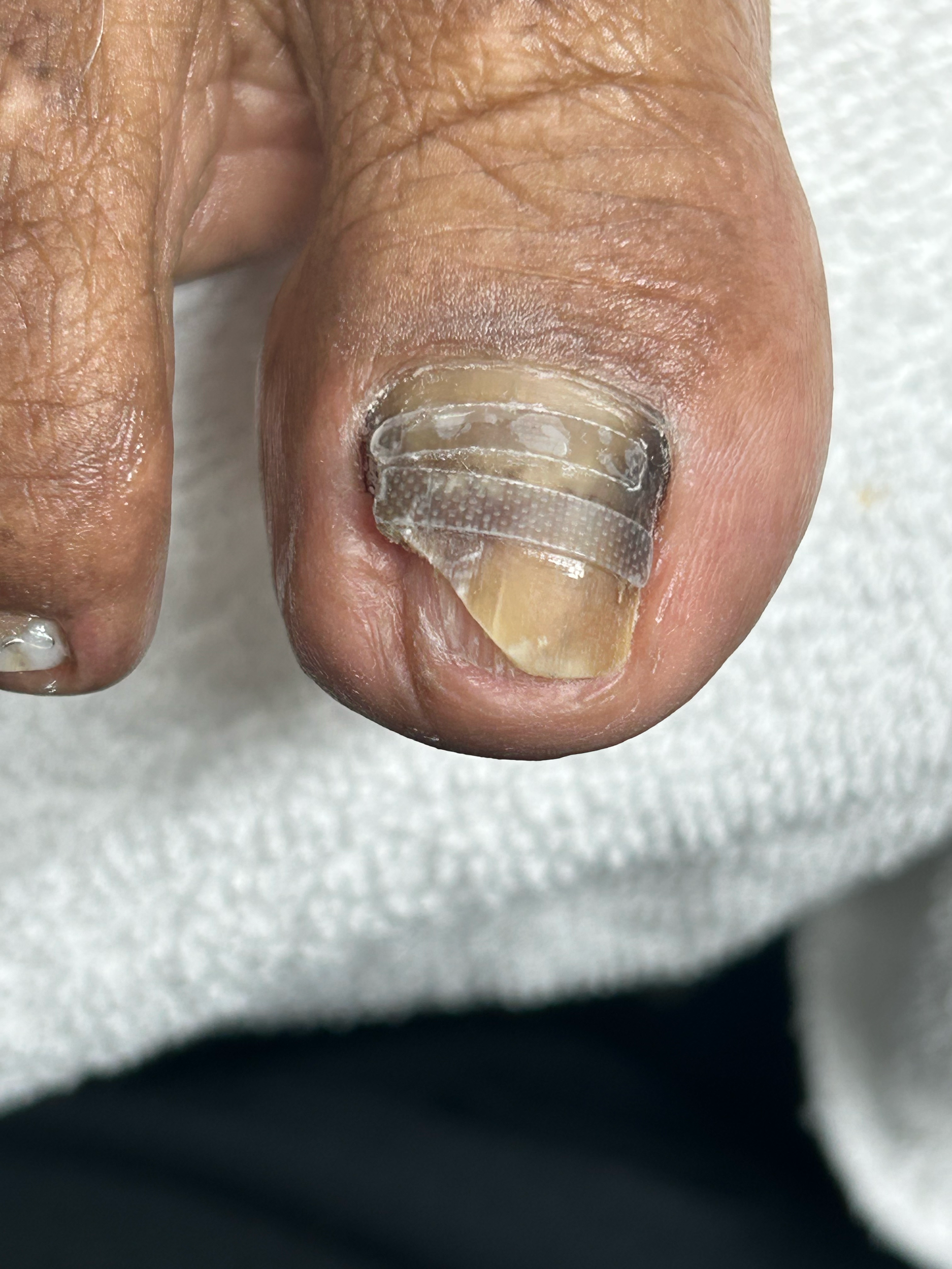 Close-up of a person’s index finger with a partially attached nail adhesive strip.