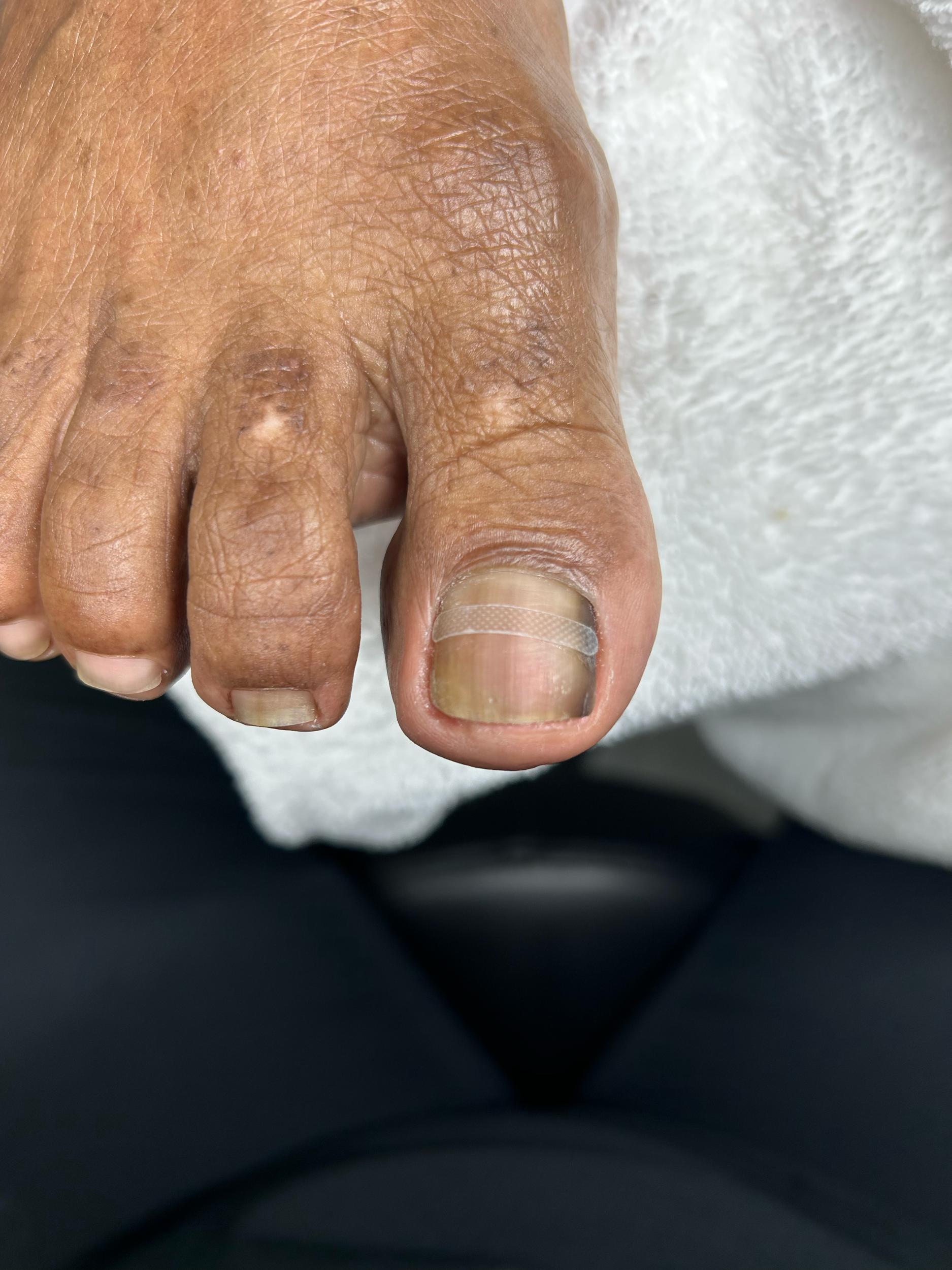 Close-up of a person's hand with dry, wrinkled skin and visible nails, resting on a white textured surface.