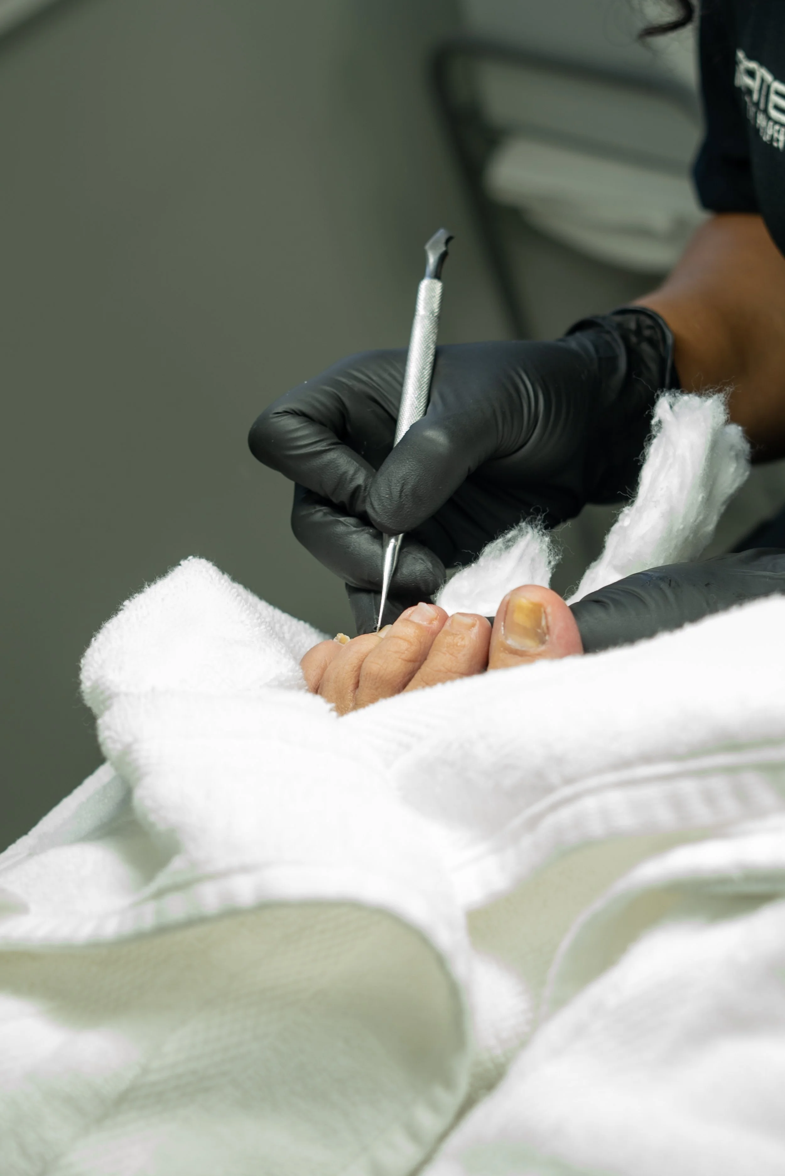 Close-up of a person receiving a medical or podiatric treatment on their toes, with a healthcare worker wearing black gloves holding a precision tool and cotton or gauze.