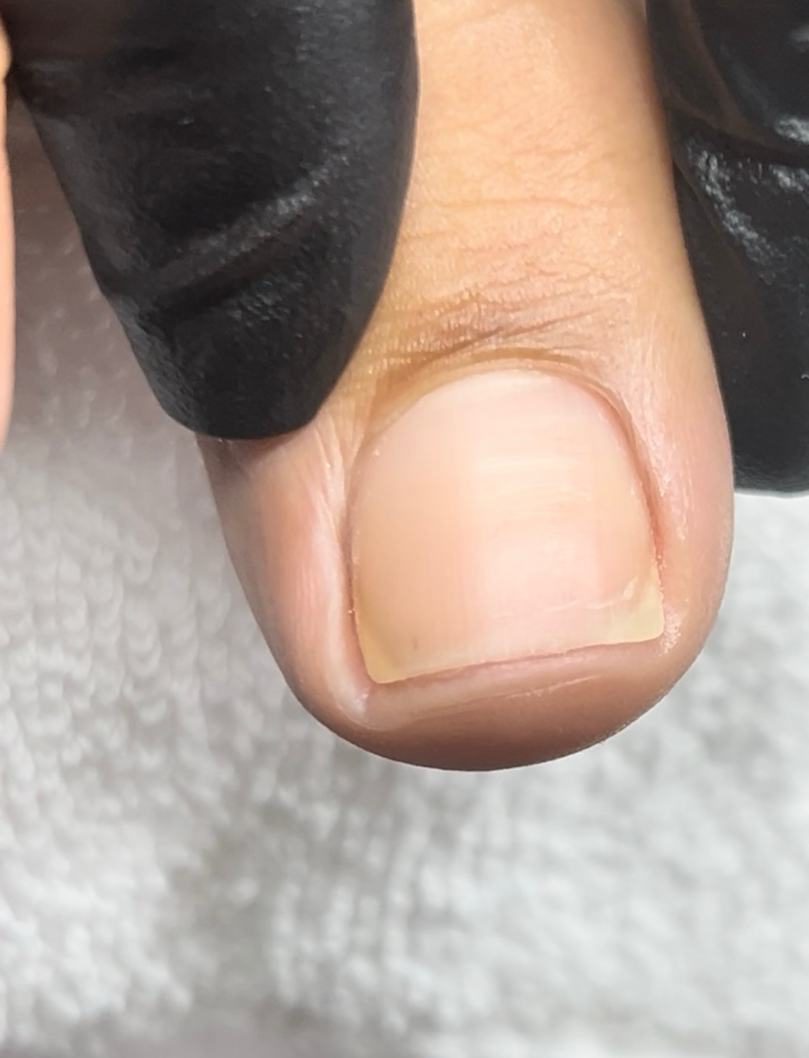Close-up of a person’s thumb with a nail growing, and a black glove partially covering the finger.