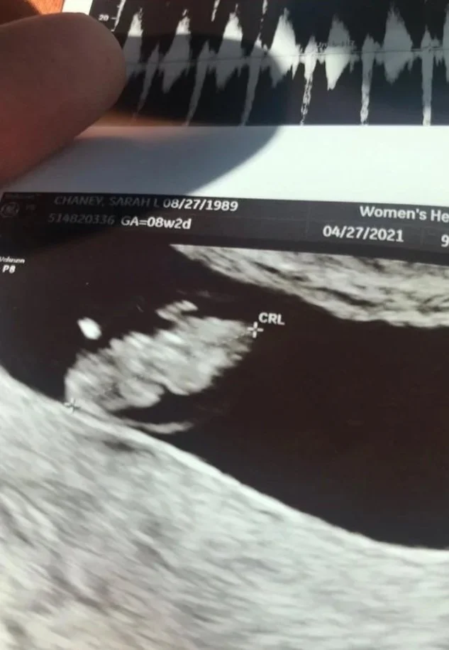 Ultrasound image of a developing fetus in the womb.