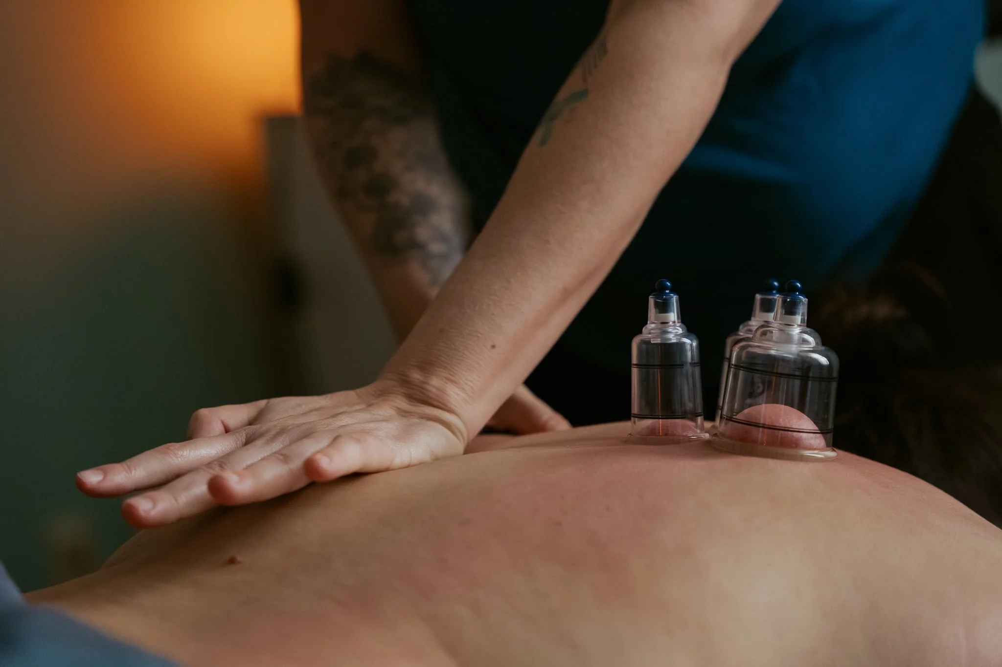 A person receiving an acupuncture treatment on their back, with several small glass cups placed around the area.