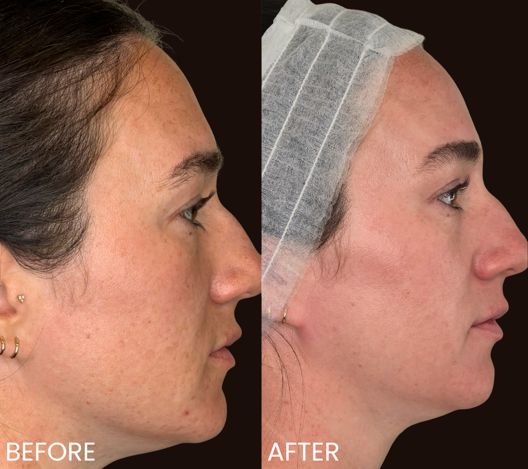 Close-up of a woman's face showing a side profile before and after skincare or cosmetic treatment, with a visible reduction in skin blemishes and improved skin texture.