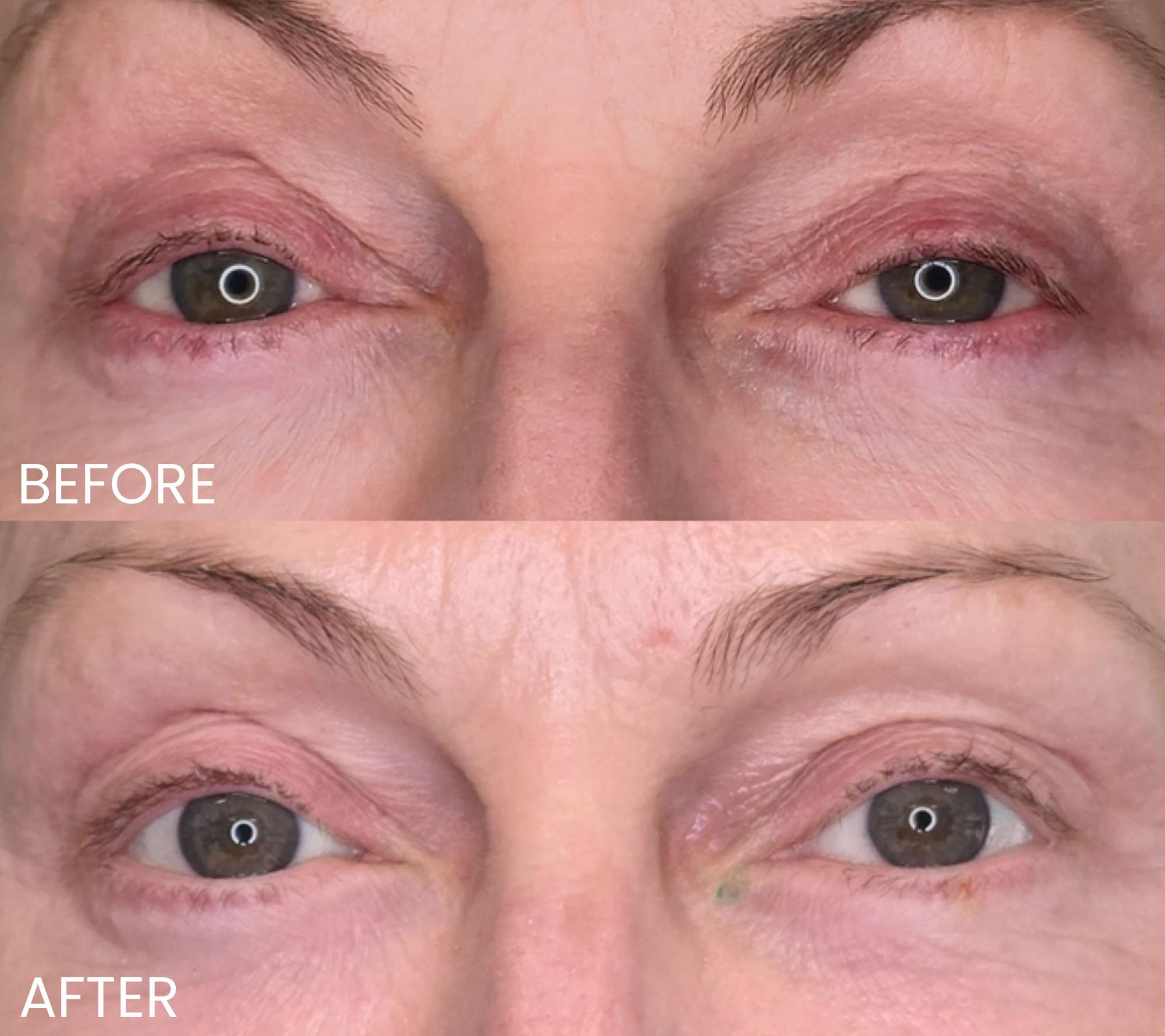 Close-up of a person's eyes and eyebrows, showing a before and after comparison of an eye area treatment or makeup application.
