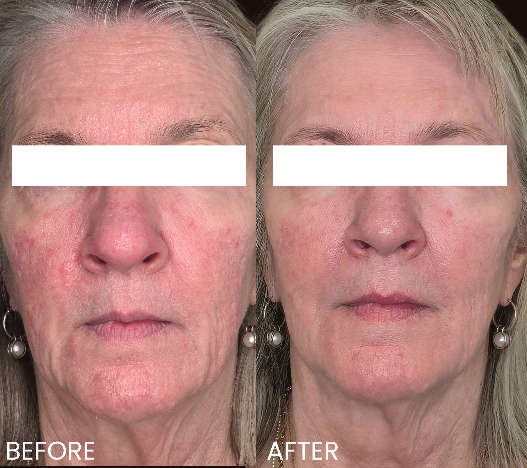 A side-by-side comparison of a woman's face showing before and after skin treatment, highlighting reduced redness, clearer complexion, and smoother skin in the after image.