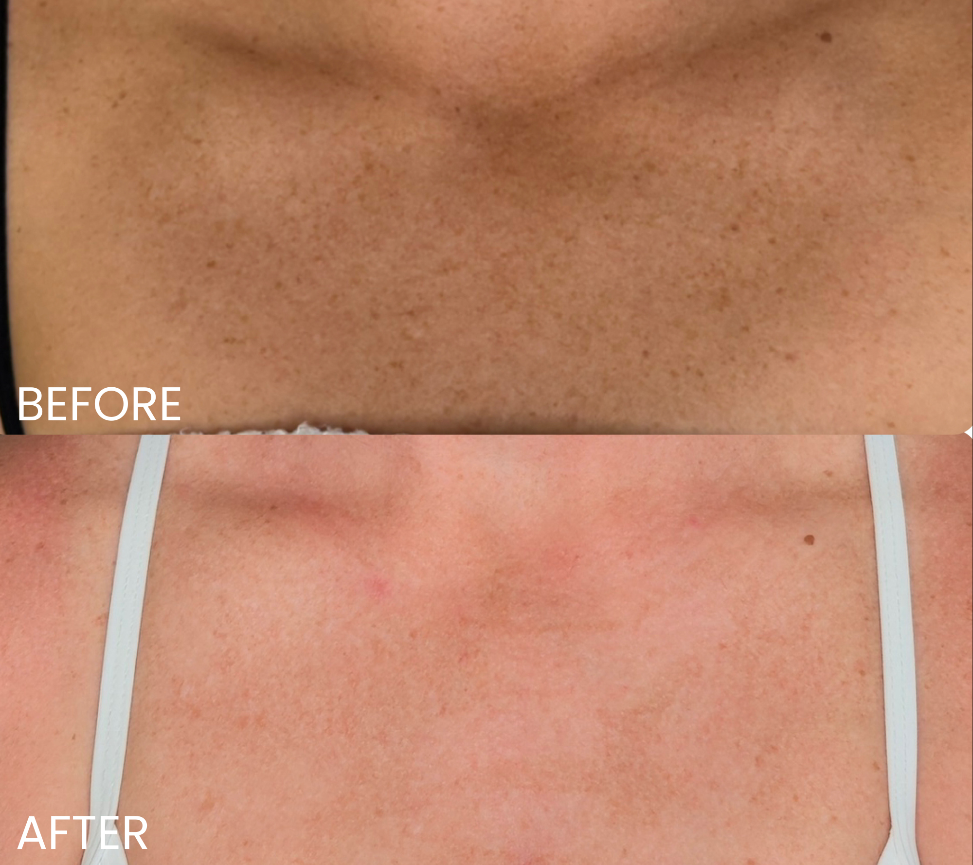 Comparison of skin before and after a treatment, showing a reduction in freckles or pigmentation.