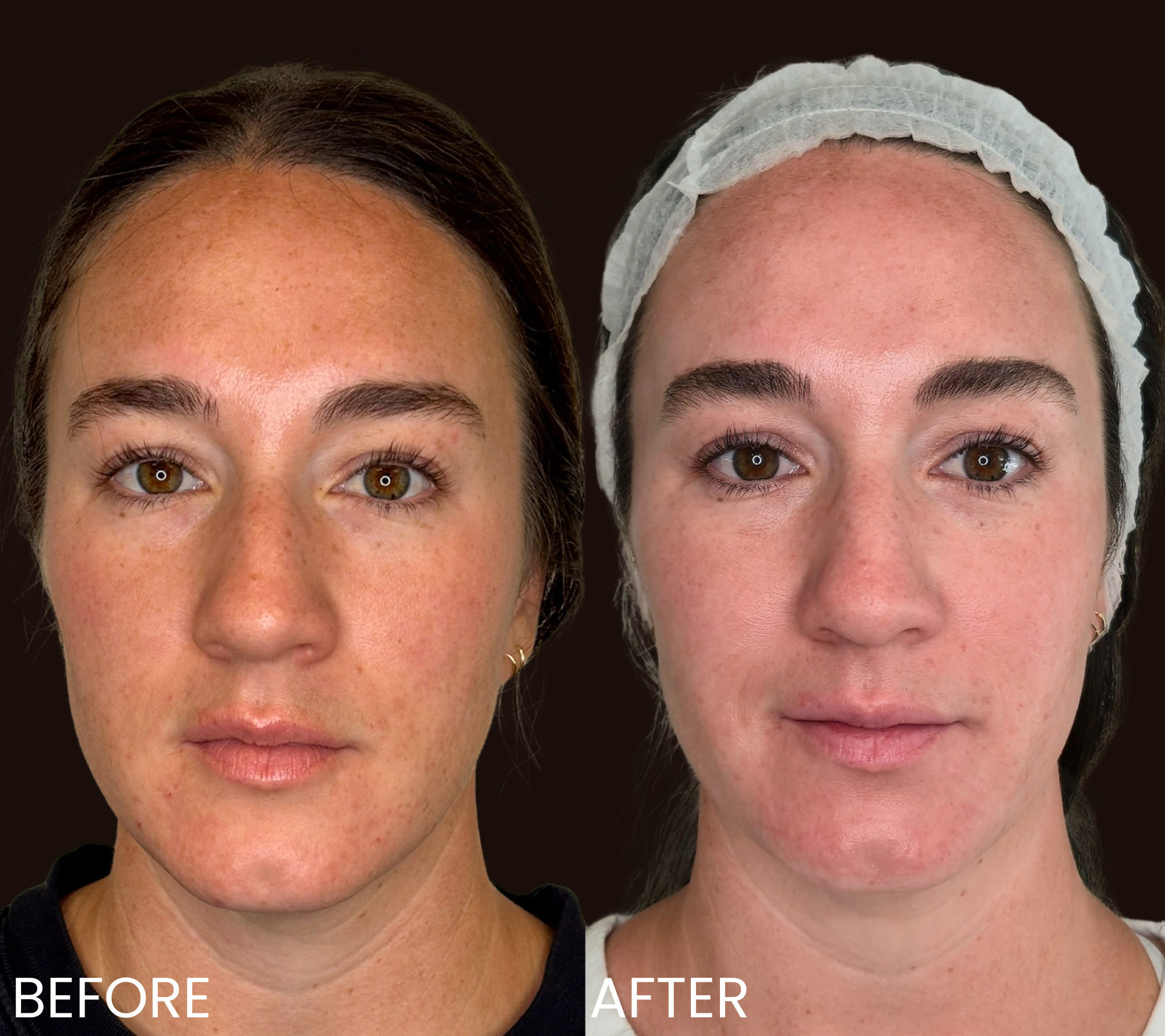 Side-by-side comparison of a woman's face before and after skincare treatment, showing reduced redness and improved skin tone. The left side is labeled 'BEFORE' and the right side 'AFTER,' with the woman wearing a cap on the right.