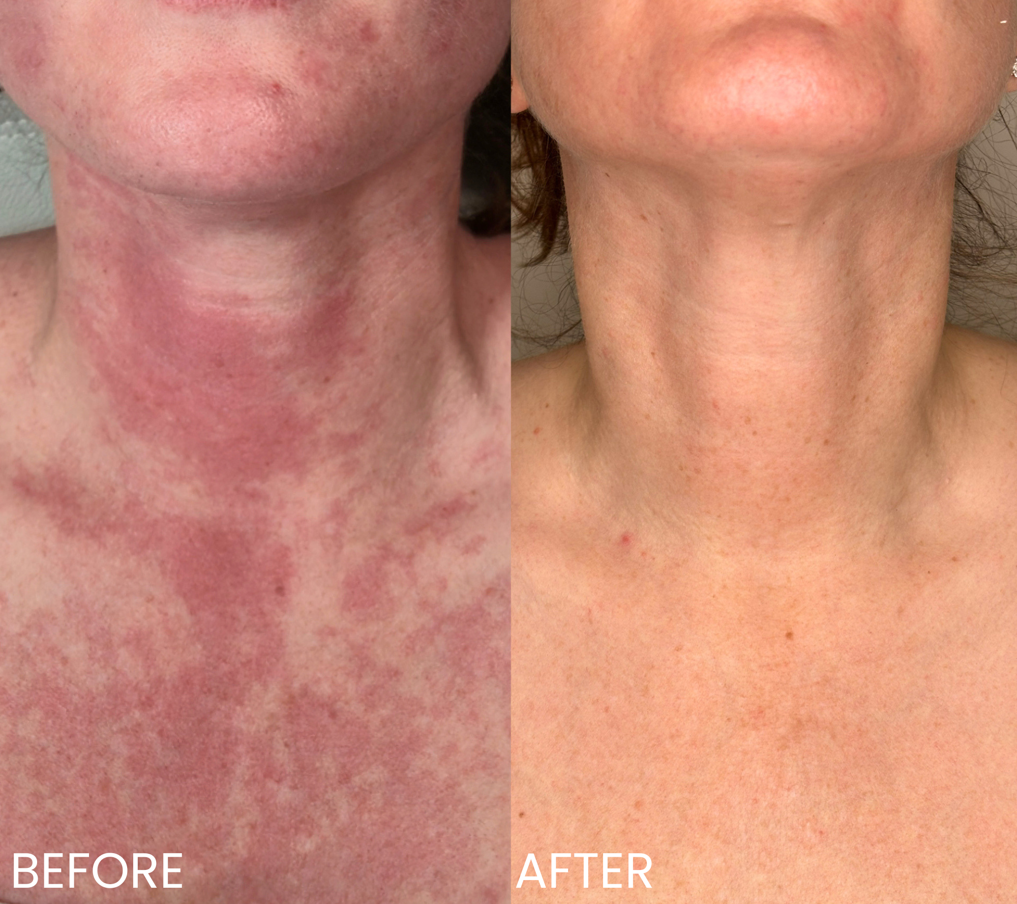 Comparison of skin on chin area labeled 'Before' and 'After'; skin appears less red and clearer in the 'After' image.