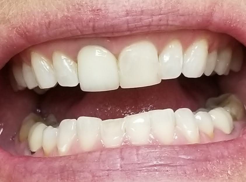Close-up of a person's open mouth showing upper and lower teeth, with some dental restorations or crowns on upper front teeth.
