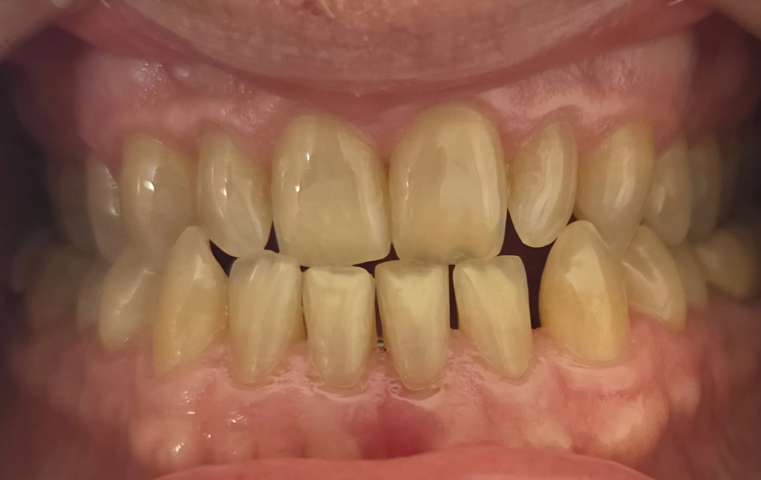 Close-up of a person's mouth showing yellowed teeth and gums.
