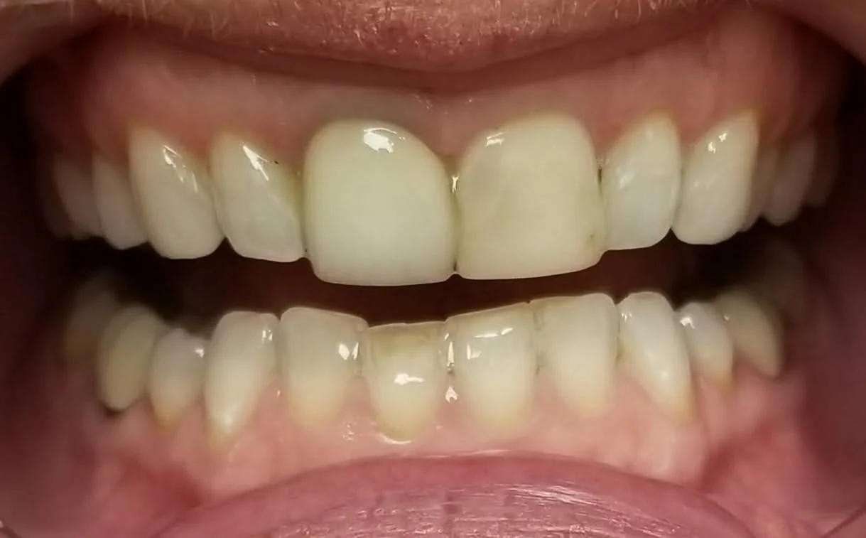 Close-up of open mouth showing teeth and gums, with some discoloration and plaque on the teeth.
