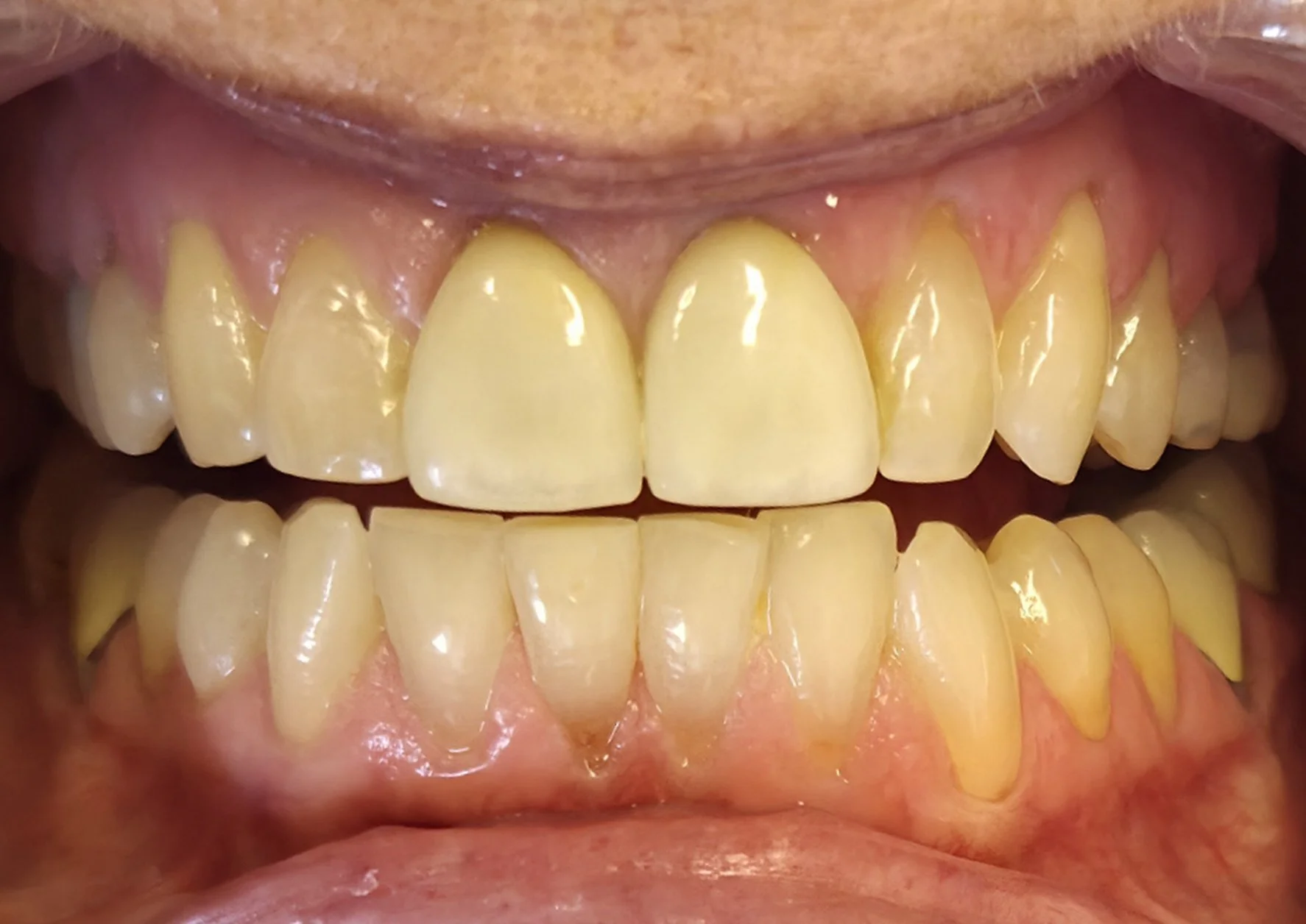 Close-up of a person's mouth showing yellow teeth.