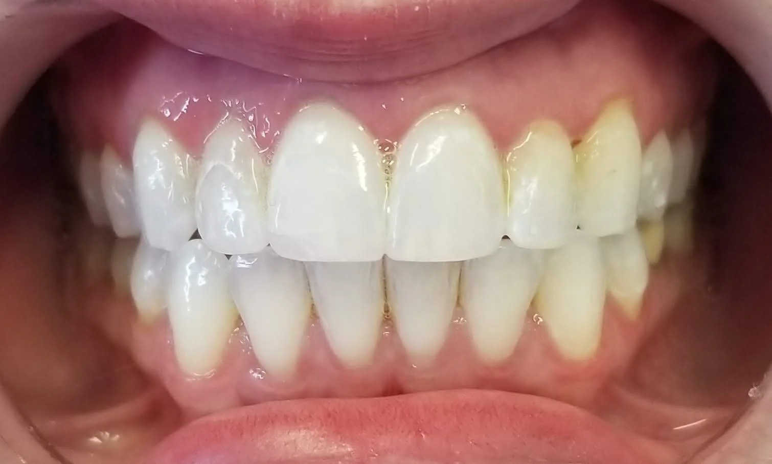 Close-up of a person's open mouth showing upper and lower teeth with some visible plaque and discoloration.
