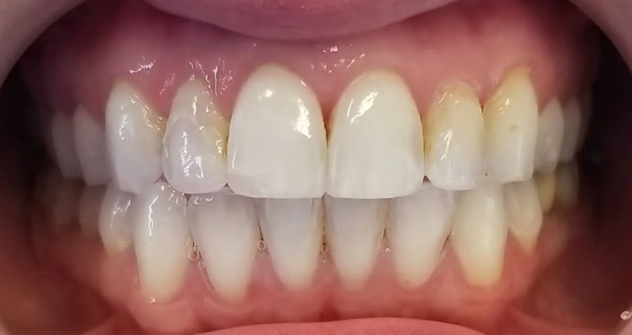 Close-up of a person's upper and lower teeth with slight plaque and staining, visible gums.