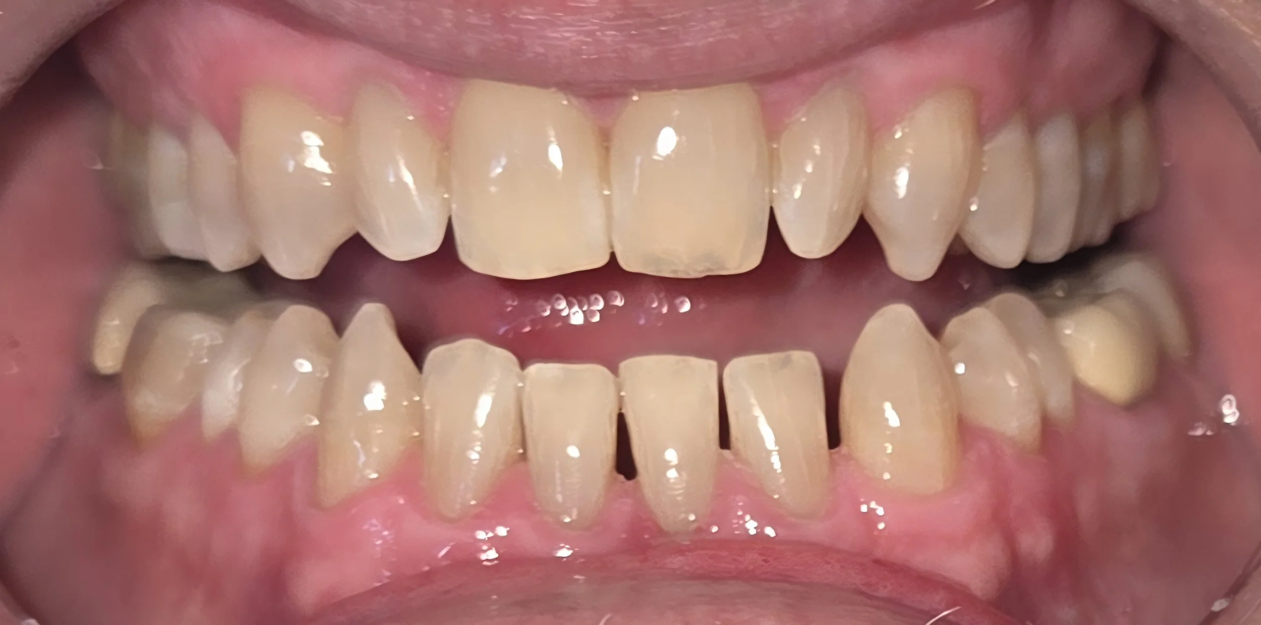Close-up image of a person's open mouth showing teeth, some of which are discolored and misaligned.