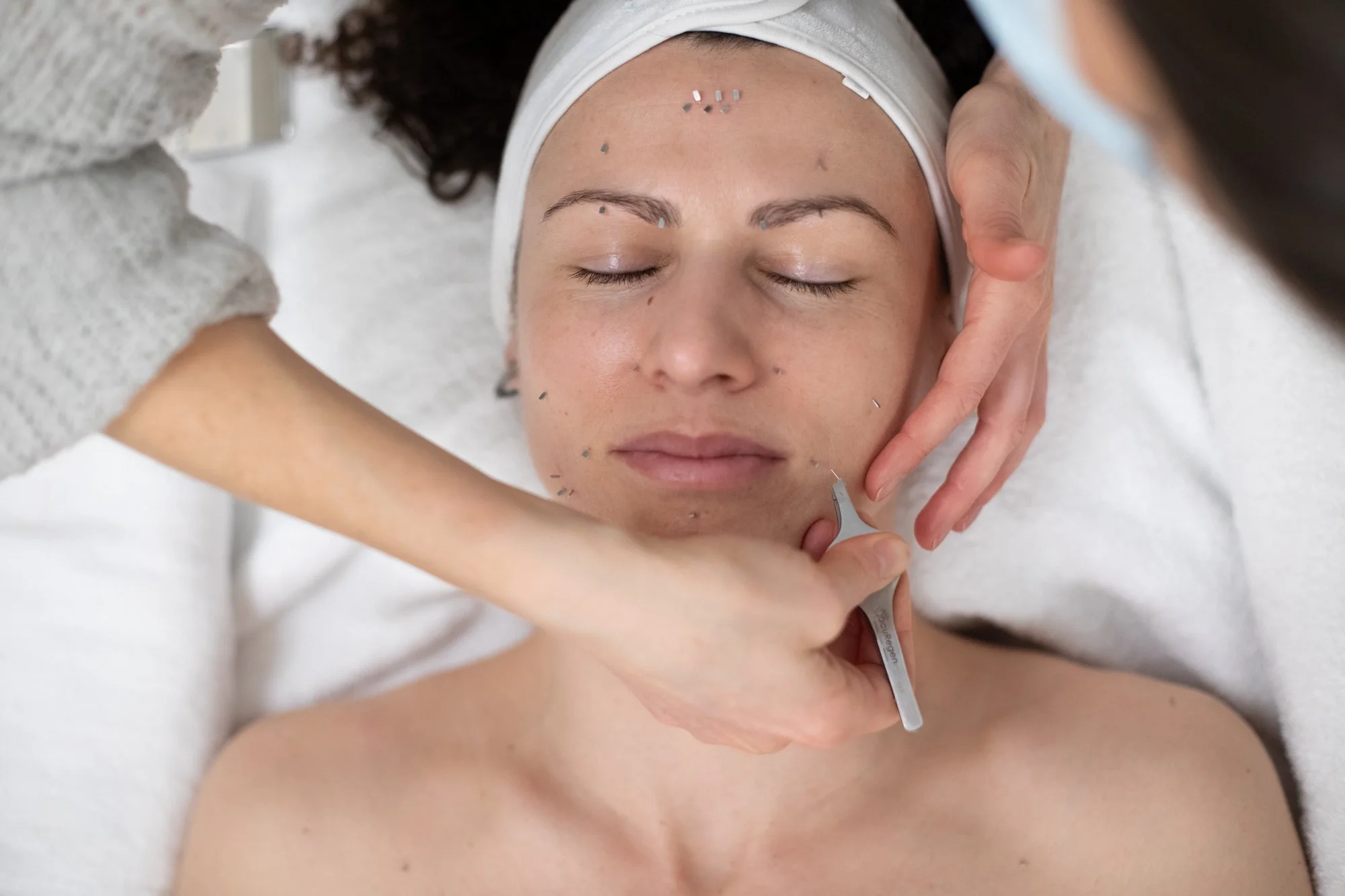 5 Reasons Why Facial Acupuncture is the Next Big Thing in Anti-Aging
