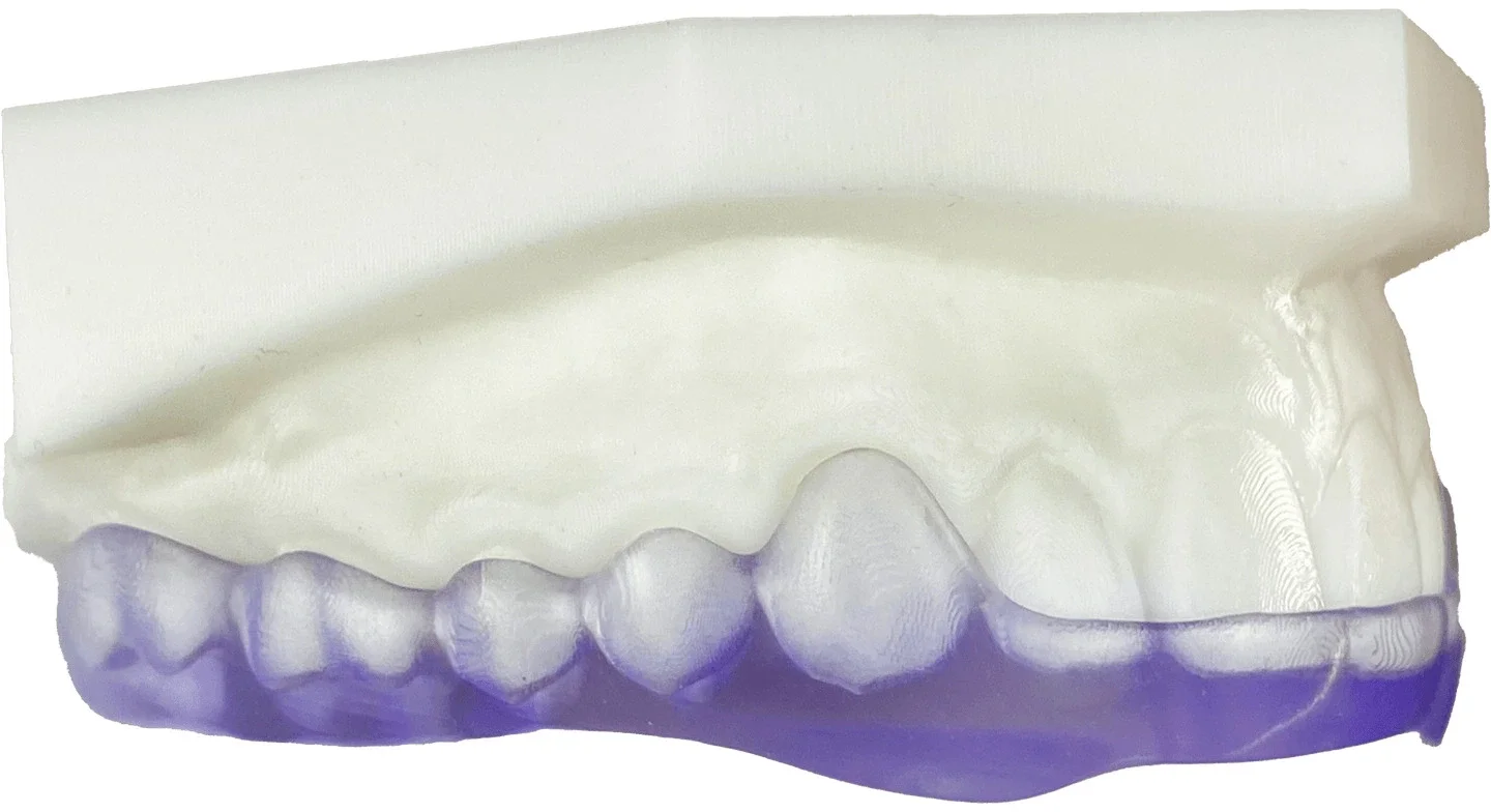 Dentale Gussmodell mit oberen und unteren Zähnen in weiß und lila