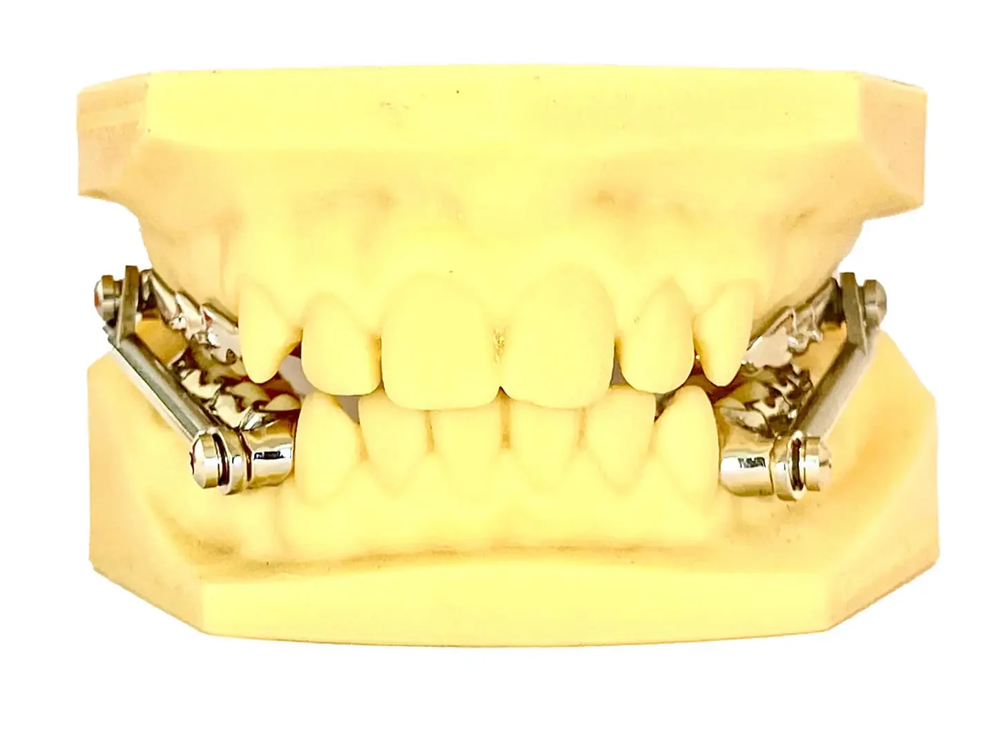 Modell eines kieferorthopädischen Abnikus mit Metall-Bail am oberen und unteren Zahnbogen
