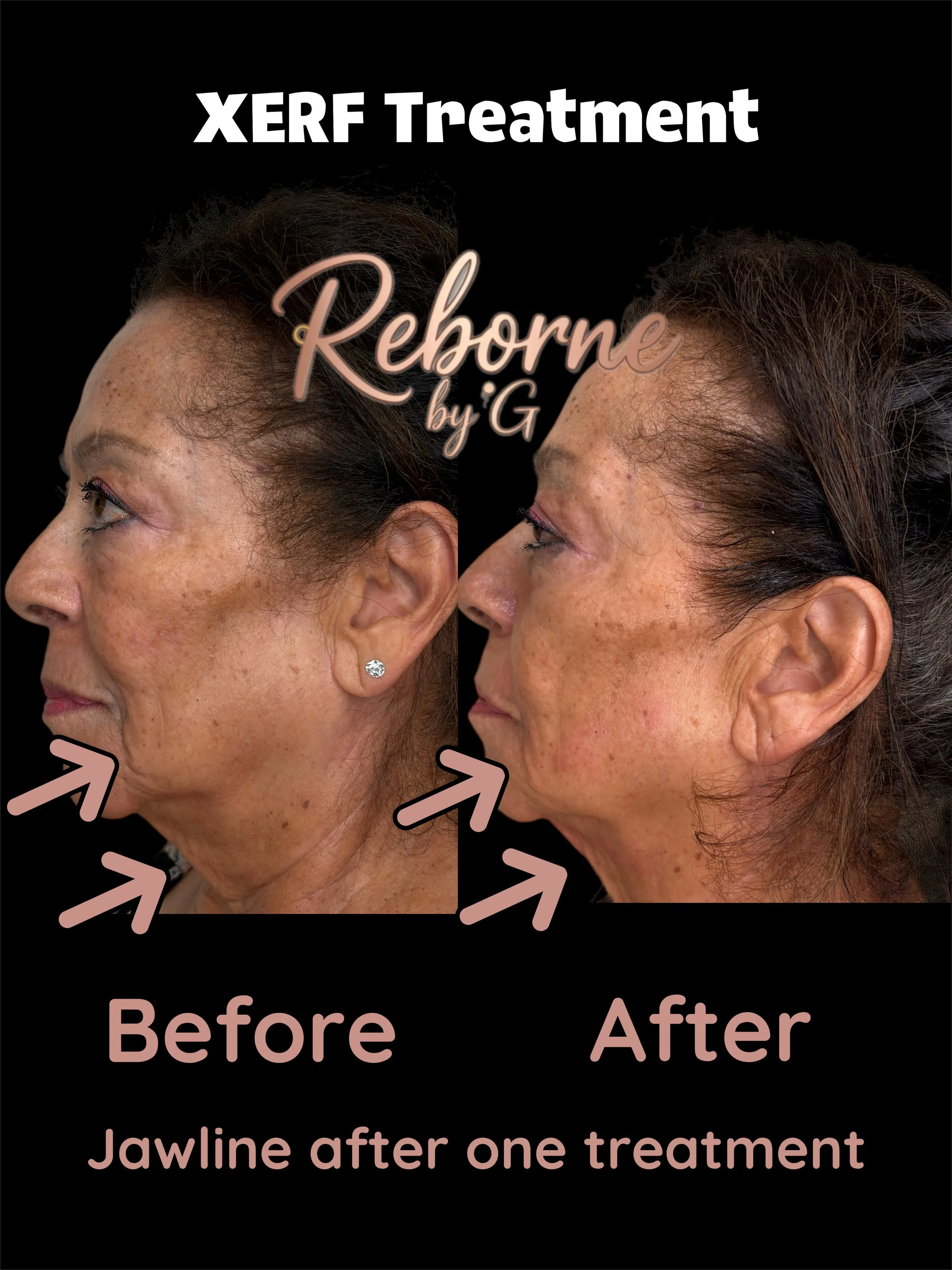 Side-by-side comparison of a woman's jawline before and after a XERF treatment, showing reduced wrinkles and skin tightening.