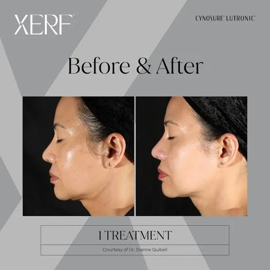 Side-by-side before and after images of a woman's face showing facial contour improvements after treatment.