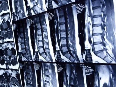 Imaging for Low Back Pain – What’s the Use?