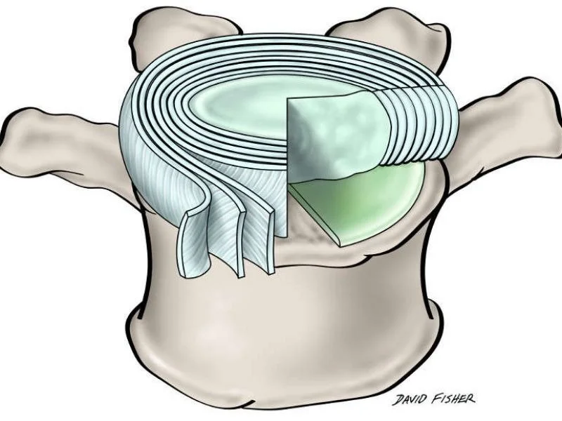 The Intervertebral Disc