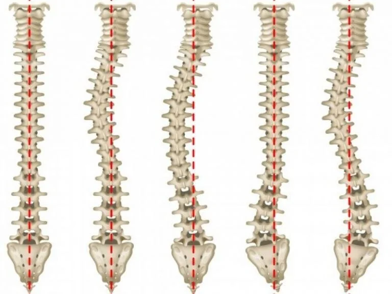 Loving Your Curves (Scoliosis)