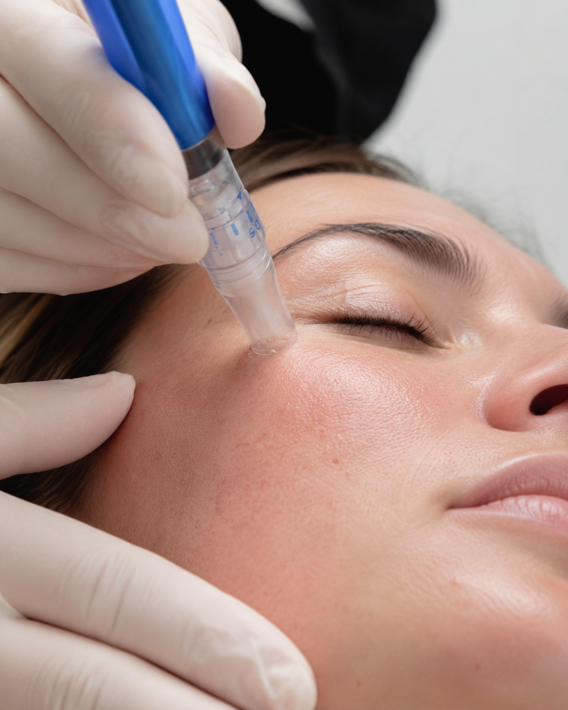 A person receiving a cosmetic injection into the face, with a healthcare professional wearing gloves holding a syringe near the person's cheek.