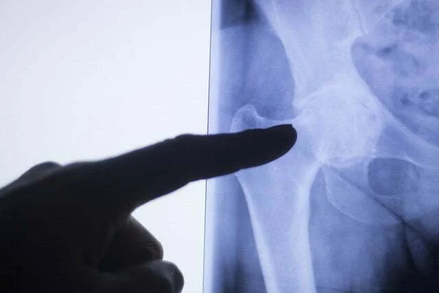 Hip or Back Pain? How Do You Know?