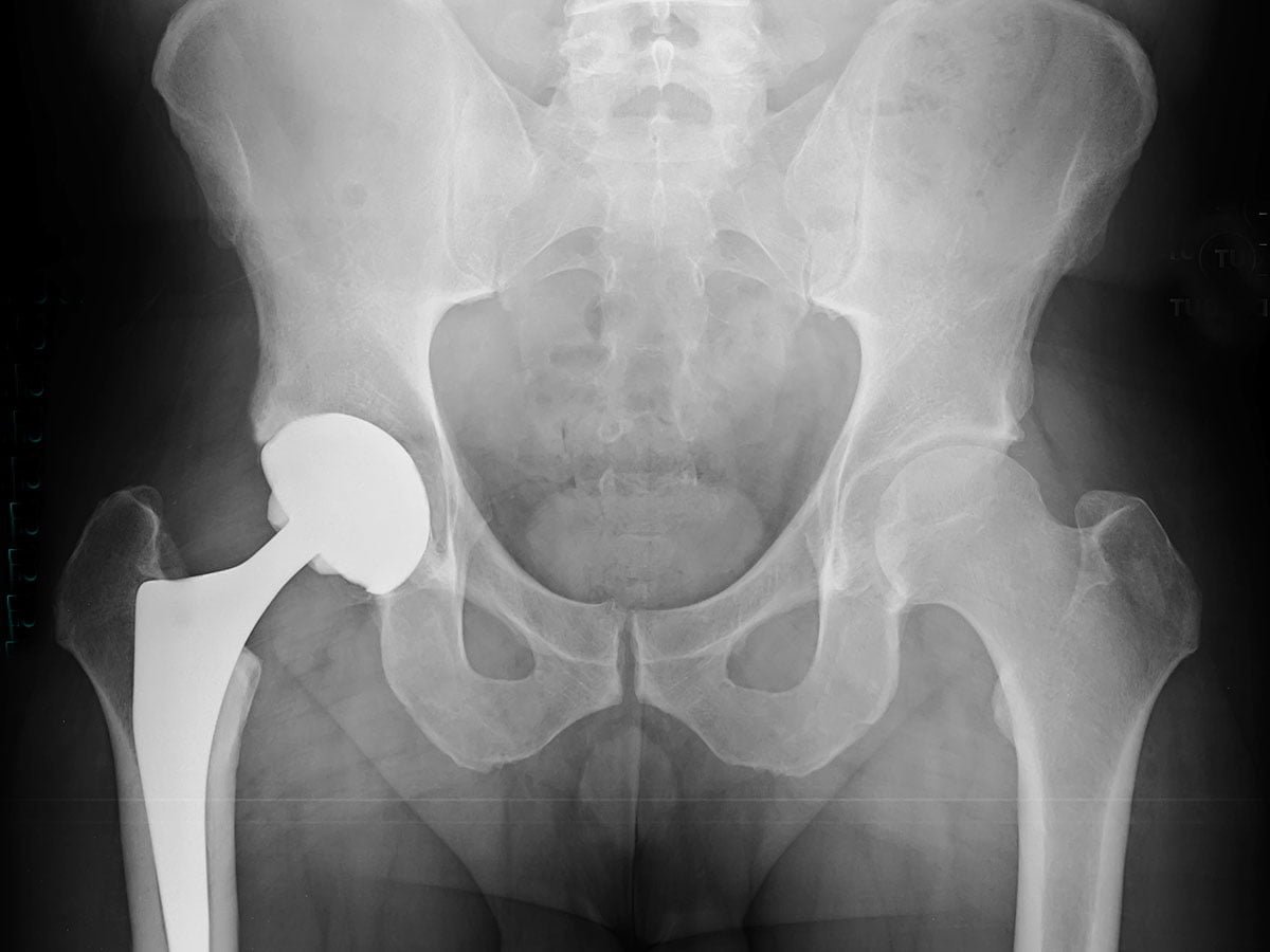 Replacement Body Parts